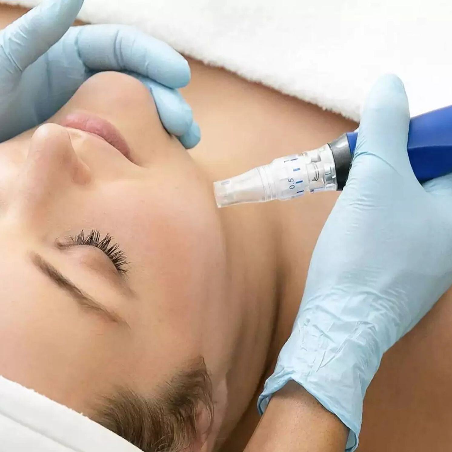 Microneedling with Skin Pen Image 11-28-24