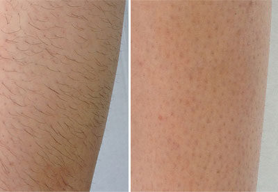 before-after-Laser Hair Removal