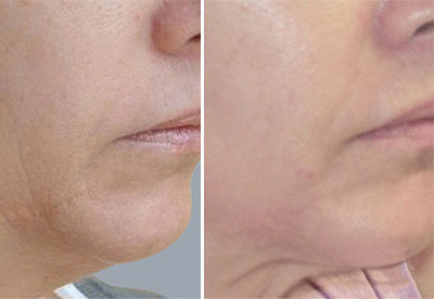 before-after-Pigmentation Treatments