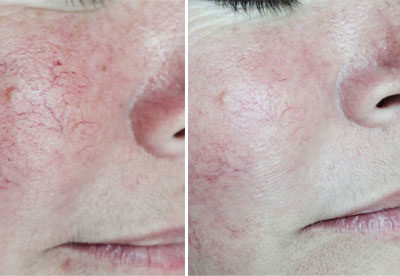 before-after-Spider Vein Removal